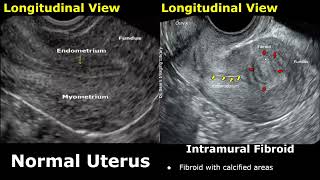 Uterus Ultrasound Normal Vs Intramural Fibroid Images  Uterine Leiomyomas USG Cases [upl. by Llahsram]