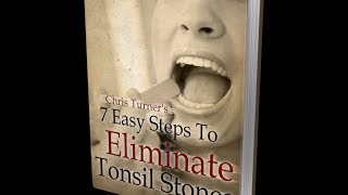 7 Easy Steps To Eliminate Tonsil Stones [upl. by Yorled]