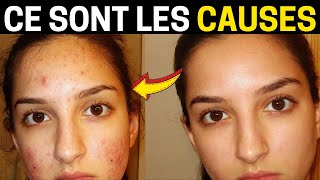 Quelles Sont les Causes des Boutons sur le Visage  Voir les 4 Principaux Facteurs [upl. by Lynnell]