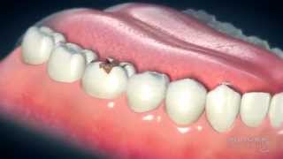 Dental Crowns Everything You Need to Know [upl. by Kerad]