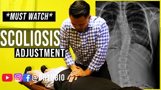 SEVERE SCOLIOSIS pain RELIEVED after Chiropractic Adjustments  Dr Alex Tubio [upl. by Lotti]