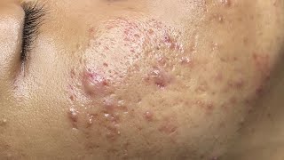 ACNE TREATMENT VU QUYNH MI  Perennial Blackheads On Boy Face 2024FULL [upl. by Aima]