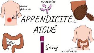 LAPPENDICITE AIGUË physiopathologie symptômes diagnostic traitement [upl. by Sherar]