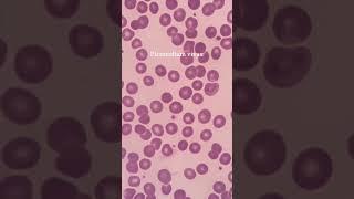 Plasmodium vivex Smear science pathologylaboratory microbiology [upl. by Idnahc]