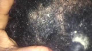 Dandruff Scratching With Comb Part 2 of 4  Amethyst amp Ruby [upl. by Leuqer]