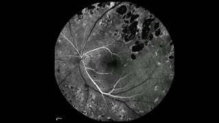 Fluorescein eye stain [upl. by Merideth]