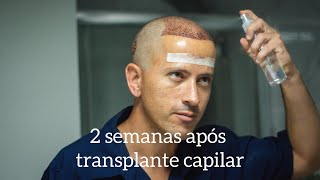 2 semana após transplante capilar [upl. by Algar]