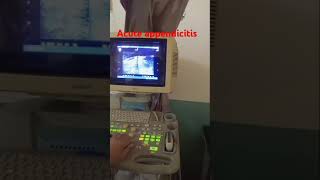 Acute Appendicitis baby boyultrasound appendicitis [upl. by Nayrda92]