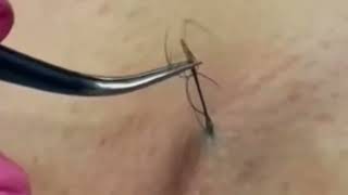 Make Your Day More Relaxing  Satisfying Plucking Ingrown Hair Process Compilationsatisfying viral [upl. by Alejna947]