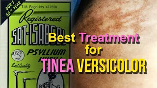 Effective Treatment for Tinea  Pityriasis Versicolor Skin Fungus  Psyllium Husk  Natural Remedy [upl. by Nodnelg128]