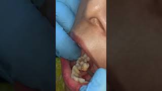 lingually erupted tooth extraction by 18 years experianced dentist in Patna  Dr Abhishek Kumar [upl. by Kirstyn]