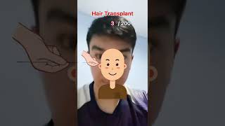 Hair transplant stickman animation [upl. by Bulley]