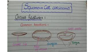 Squamous Cell Carcinoma Of Mouth  Gross and Microscopic features [upl. by Obeded]