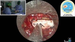 Rt L5S1 endo discectomy [upl. by Sirod]