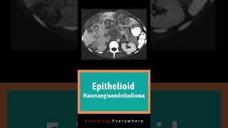 Epithelioid Haemangioendothelioma of the liver  Radiology tutorials  video 58 [upl. by Anastasia]