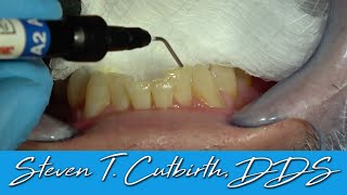 Bonding Incisal Edges of Anterior Teeth  Dental Minute with Dr Steven T Cutbirth DDS [upl. by Ongun]