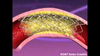 Heartistry Stent Implant Animation [upl. by Letney587]