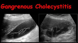 Gangrenous Cholecystitis [upl. by Cleland]