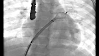 PULMONARY VENOUS METHOD FOR TRANSCATHETER ASD CLOSURE XRAY [upl. by Carita]