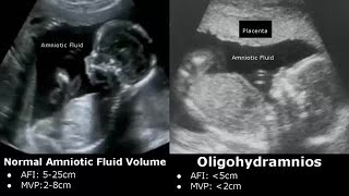 Obstetric Ultrasound Normal Vs Abnormal Images  Fetal Placenta Umbilical Cord Pathologies USG [upl. by Siblee]