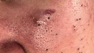 Popping Blackheads amp Whiteheads  Acne Skin Care [upl. by Toinette]