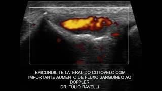 ULTRASSOM DO COTOVELO  EPICONDILITE LATERAL COM FLUXO AO DOPPLER [upl. by Sik]