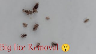 Lice Removal In Moms Black And White Hair   Nits Picking ASMR [upl. by Florinda]