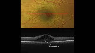 Cystoid Macular Edema in Pars Planitis OCT Interpretation [upl. by Ahael867]