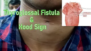 Thyroglossal Fistula amp Hood Sign [upl. by Pollitt405]