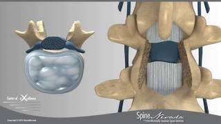 Lumbar Laminectomy and Fusion Presented by Swift Institute Reno Spine Surgeons and Spine Center [upl. by Phylys871]