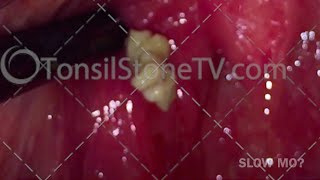 Lots of tonsil stones hiding in the tonsil [upl. by Cedric]