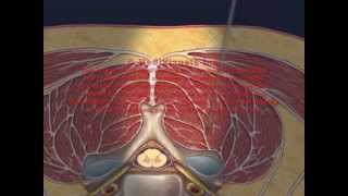 Cervical Interlaminar Epidural Injection Animation [upl. by Akcebar808]