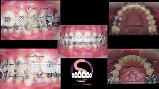 Bimaxillary protrusion treated without extraction🤔 Mostafa Elshafey [upl. by Rraval682]