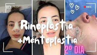 Rinoplastia  mentoplastia  Segundo dia [upl. by Chapin626]