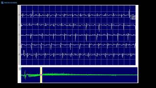 Kimura amp Kohara F14 Myotonic discharge without clinical myotonia [upl. by Dyann484]