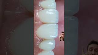 FECHAMENTO DE ESPAÇOS  DIASTEMAS COM RESINAS dentista facetadental odontologia [upl. by Treve]