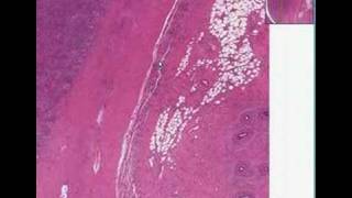 Histopathology TestisOrchitis and epididymitis [upl. by Tjader956]