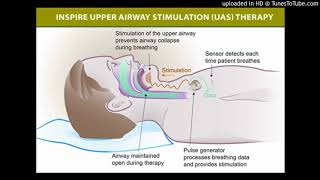 Hypoglossal nerve stimulation for obstructive sleep apnea [upl. by Eveivenej106]