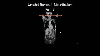 Urachal RemnantDiverticulum Part 3 radiology radiologist embryology urinarybladder [upl. by Anneiv]