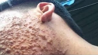 Big Cystic Acne Blackheads Extraction Blackheads amp Milia Whiteheads Removal Pimple Popping [upl. by Tella]