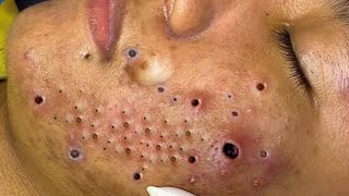 New Blackheads here ​⁠BYoungSpa [upl. by Aitetel]