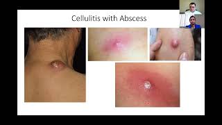 Diagnosis and Treatment of Cellulitis [upl. by Cimah]