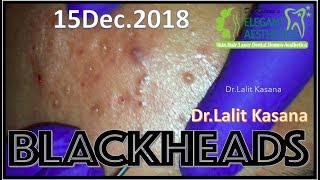 BLACKHEAD REMOVAL 15 Dec 2018 by DrLalit Kasana [upl. by Namrak]