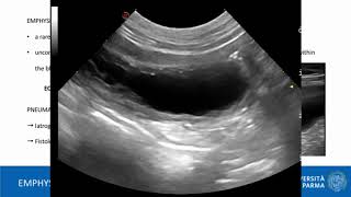 Emphysematous cystitis diagnosis and management challenges  Video abstract ID 210463 [upl. by Marius]