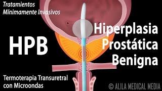 Hiperplasia Prostática Benigna HPB y Tratamientos Alila Medical Media Español [upl. by Gibbie]