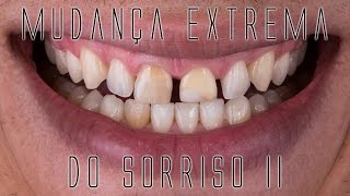 Mudança extrema do sorriso II Os bastidores das facetas e lentes de contato dentais [upl. by Dempsey]