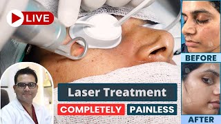 Freckles Laser Treatment  Best Freckles Laser Treatment in Delhi NCR  SkinQure  Dr Jangid [upl. by Delphine99]