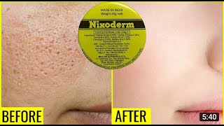 Nixoderm Cream Usage Reviews  Colorful World [upl. by Atekahs]