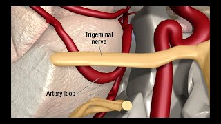 Treatment for Trigeminal Neuralgia UCSF Neurosurgery [upl. by Rebmyk266]