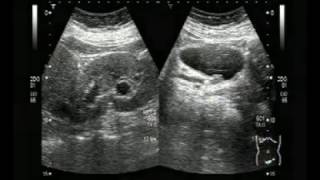 Ultrasound Video showing tracing of a very small stone in Ureter [upl. by Shurlocke]